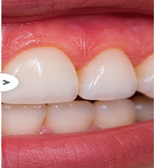 Illustrative after view for Gingivectomy