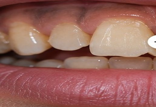 Illustrative before view for Composite Veneers