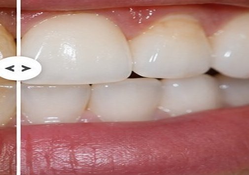 Illustrative after view for Teeth Whitening