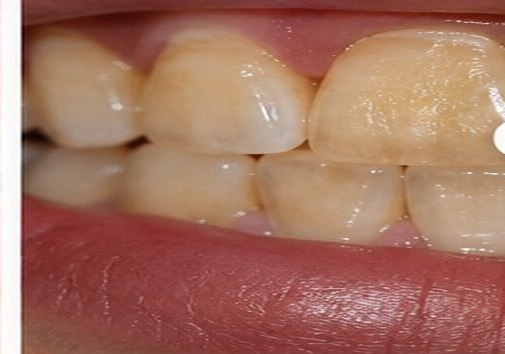 Illustrative before view for Teeth Whitening
