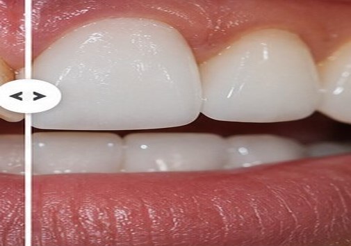 Illustrative after view for E-max Veneers
