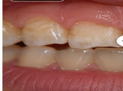 Illustrative before view for Tooth Bonding (Composite)
