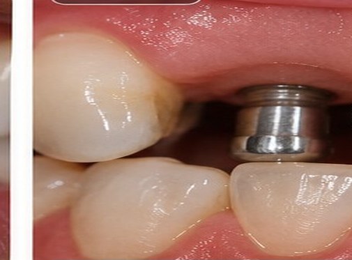 Illustrative before view for Dental Implants