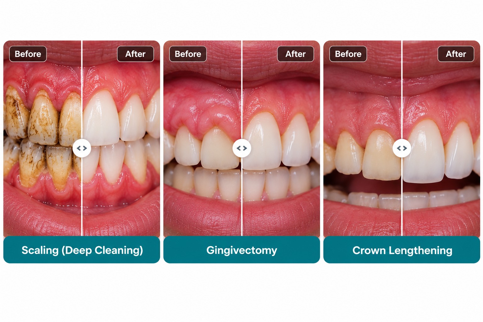 Scaling, gingivectomy and crown lengthening case examples
