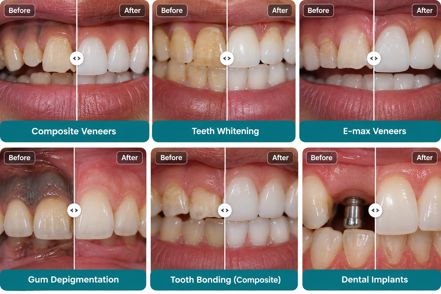 Composite veneers, teeth whitening, E-max veneers, gum depigmentation, tooth bonding and dental implants case examples