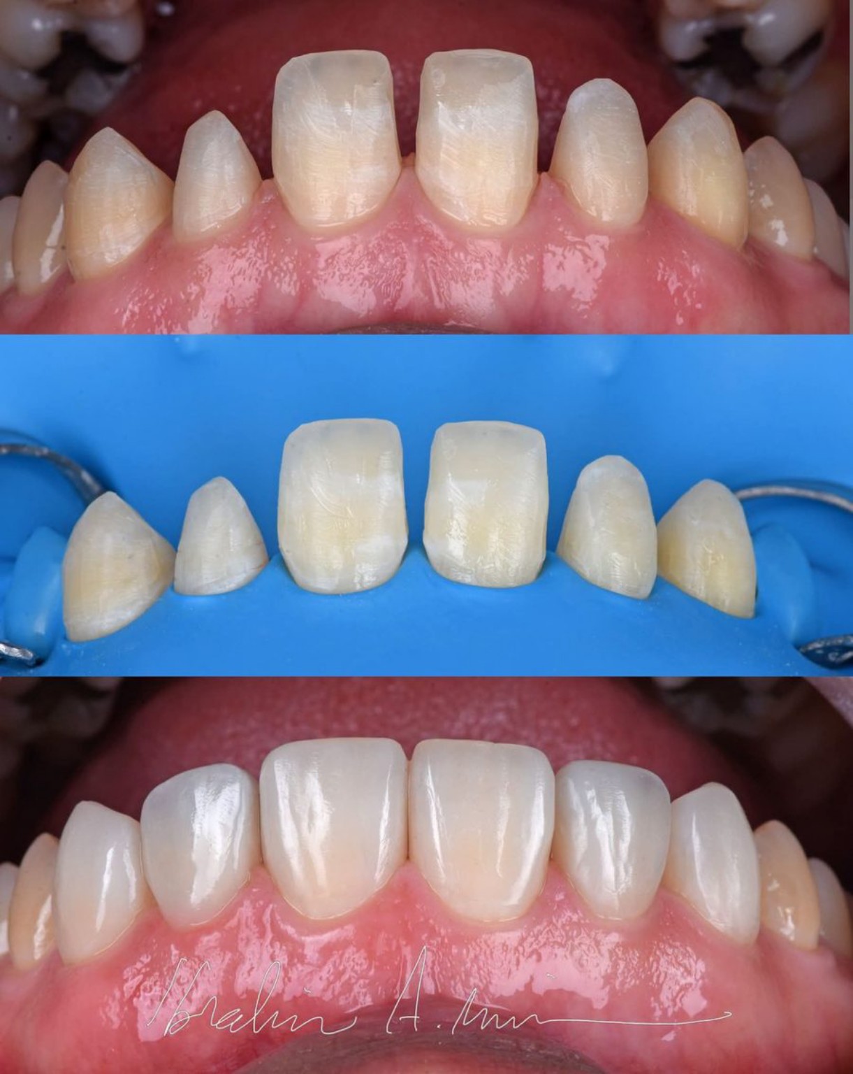 Patient dental smile case 1 at Care Plus Dental Clinic in Hurghada